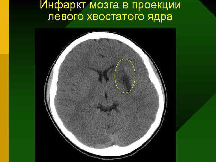Инфаркт мозга в проекции левого хвостатого ядра 