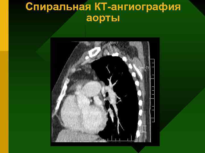 Спиральная КТ ангиография аорты 