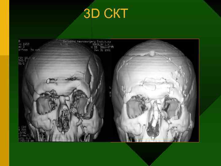 3 D СКТ 
