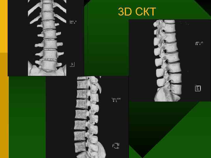 3 D СКТ 