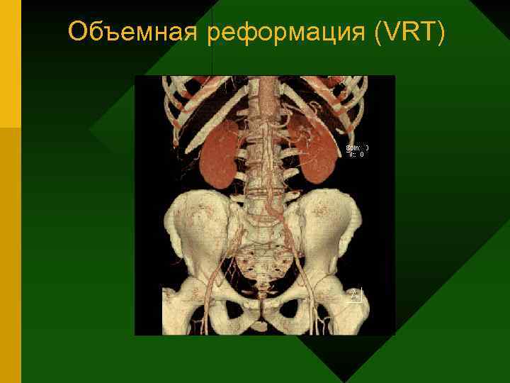 Объемная реформация (VRT) 