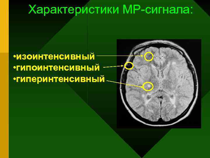 Очаги повышенной интенсивности