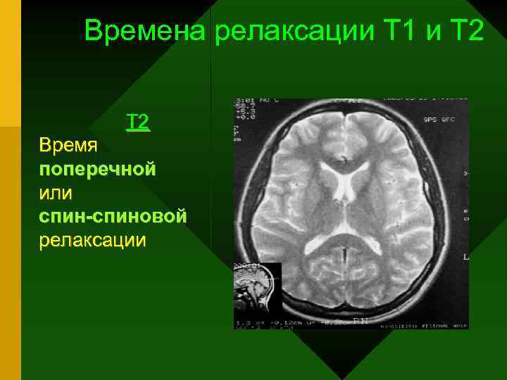 Времена релаксации Т 1 и Т 2 Время поперечной или спиновой релаксации 