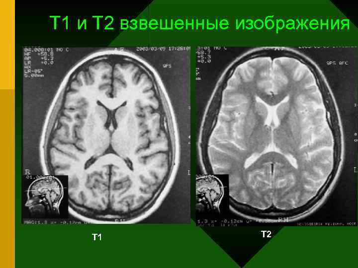 На т2 взвешенных изображениях при нативной магнитно резонансной томографии хорошо визуализируются