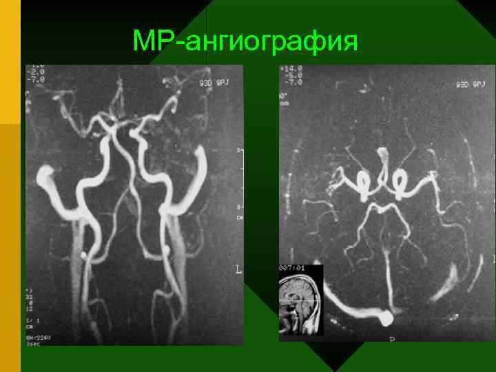 МР-ангиография 