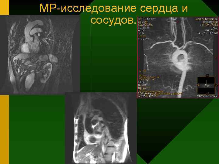 МР-исследование сердца и сосудов. 