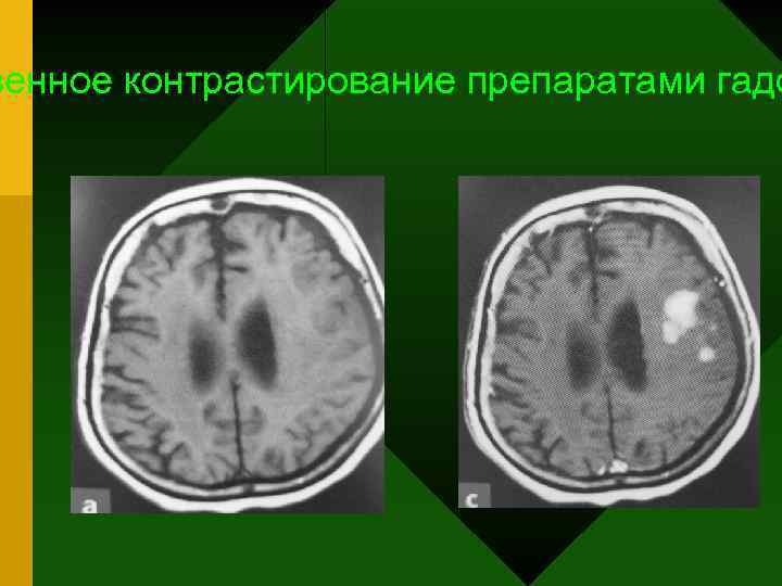 венное контрастирование препаратами гадо 