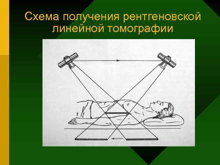 Схема получения рентгеновской линейной томографии 