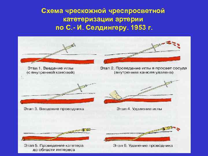 Пункция подключичной вены по сельдингеру. Катетеризация сосудов по Сельдингеру. Пункция сосудов по Сельдингеру. Катетеризация вен по Сельдингеру. Катетеризация сосуда по с. Сельдингеру этапы.