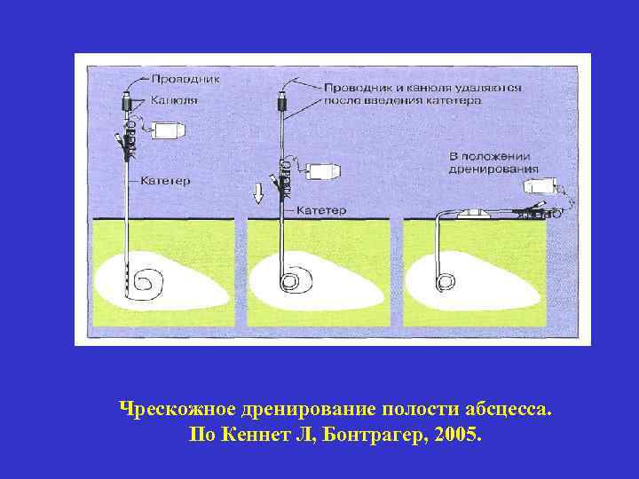 Чрескожное дренирование полости абсцесса. По Кеннет Л, Бонтрагер, 2005. 