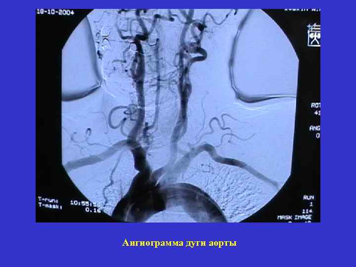 Ангиограмма дуги аорты 