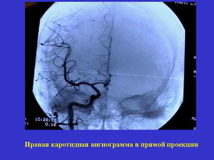 Правая каротидная ангиограмма в прямой проекции 