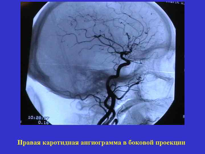 Правая каротидная ангиограмма в боковой проекции 