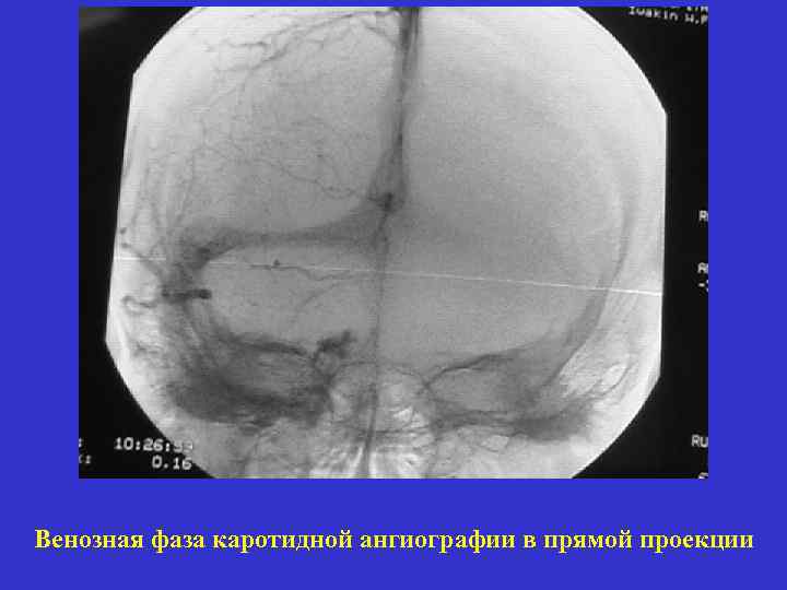 Венозная фаза каротидной ангиографии в прямой проекции 