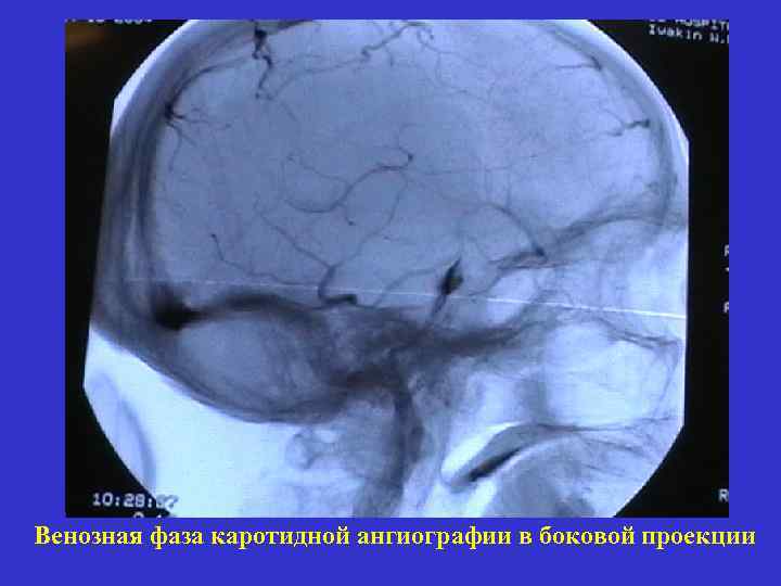 Венозная фаза каротидной ангиографии в боковой проекции 