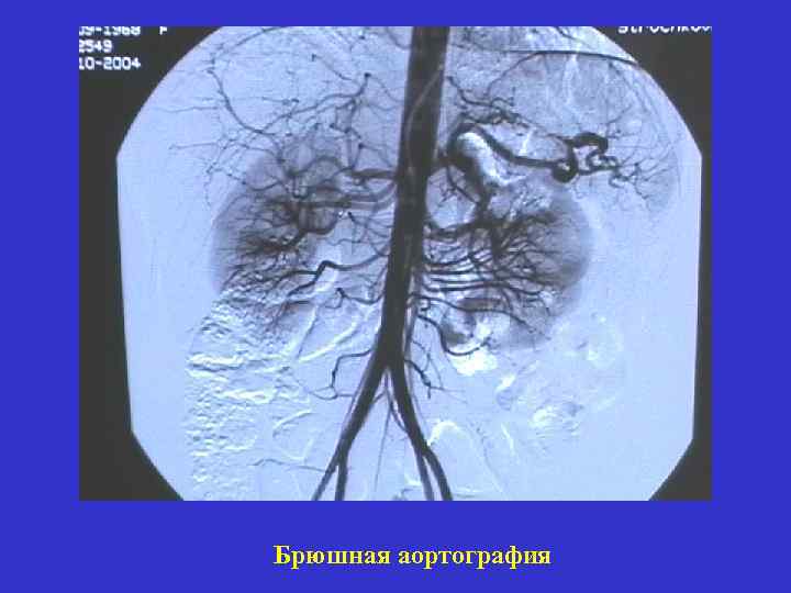 Брюшная аортография 