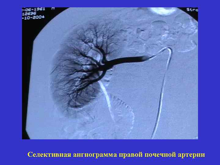 Селективная ангиограмма правой почечной артерии 