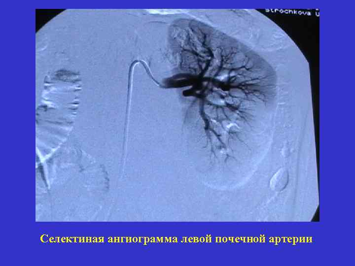 Селектиная ангиограмма левой почечной артерии 