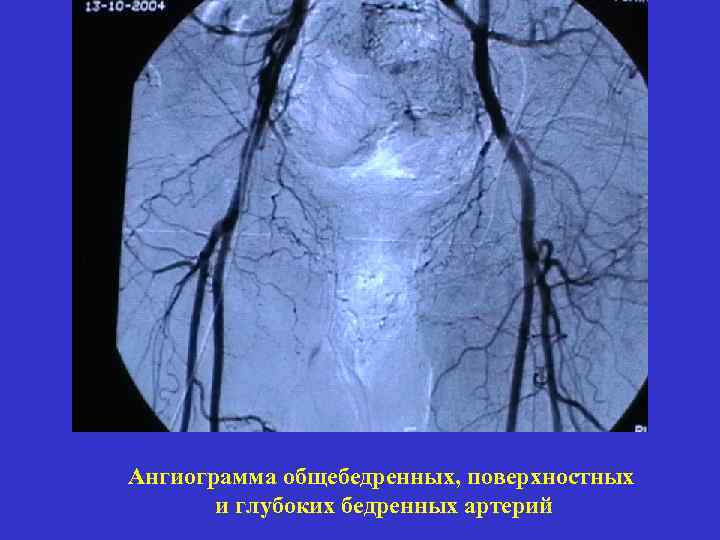 Ангиограмма общебедренных, поверхностных и глубоких бедренных артерий 