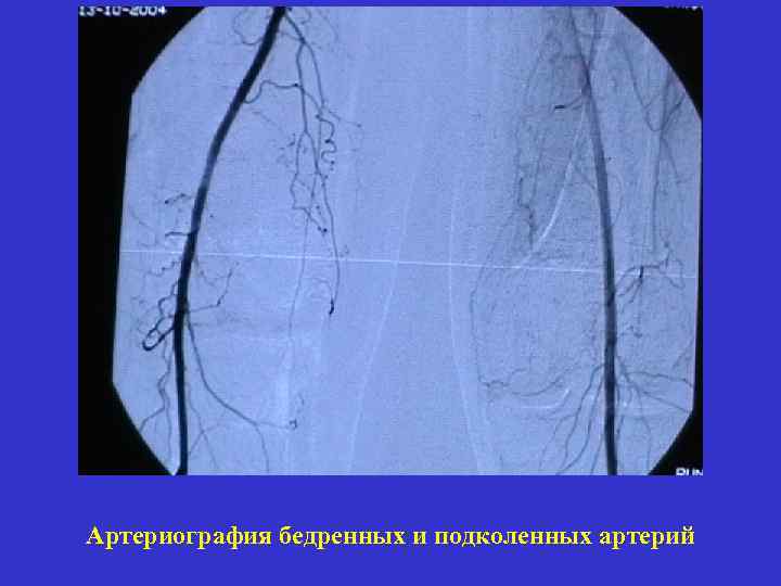 Артериография бедренных и подколенных артерий 