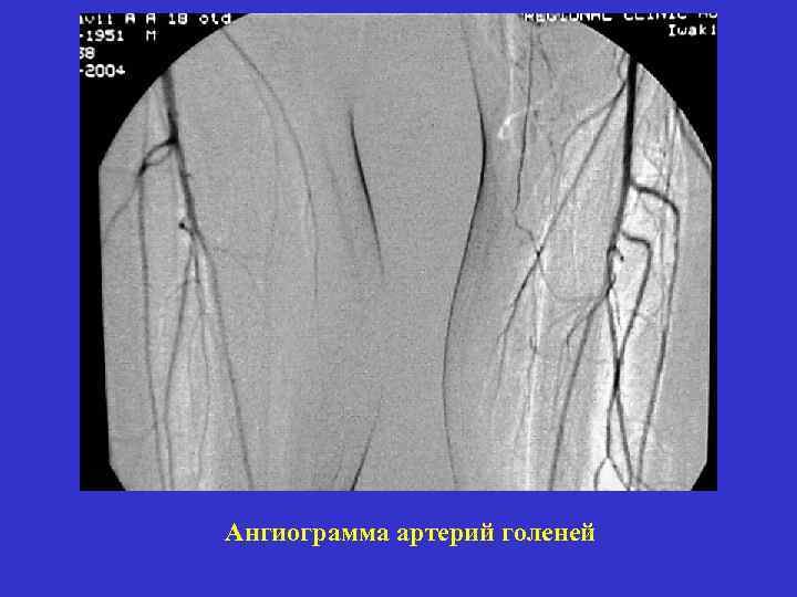 Ангиограмма артерий голеней 