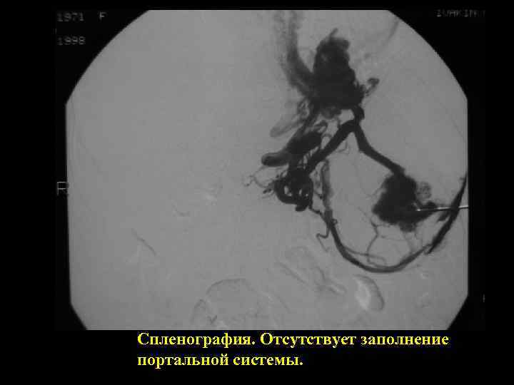 Спленография. Отсутствует заполнение портальной системы. 