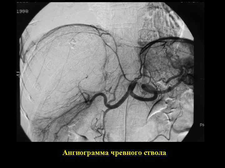 Ангиограмма чревного ствола 