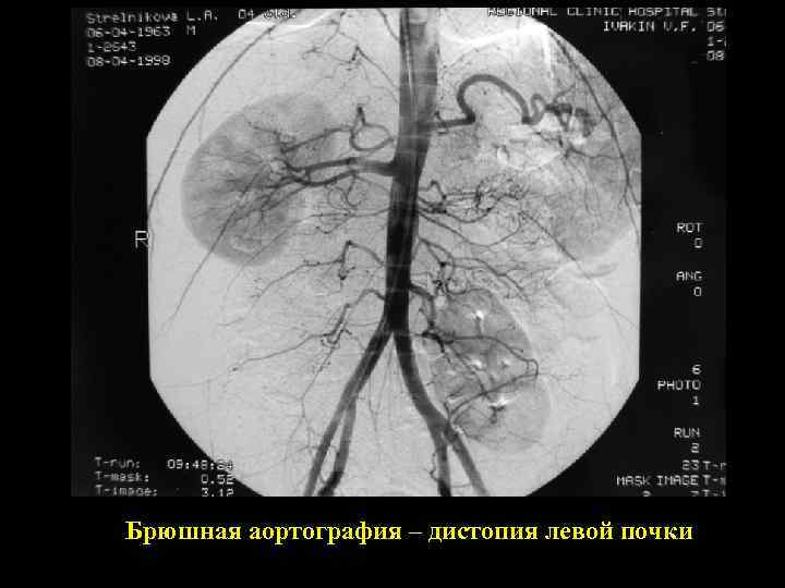 Брюшная аортография – дистопия левой почки 