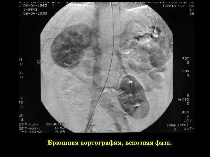 Брюшная аортография, венозная фаза. 