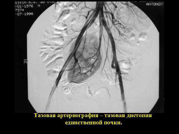 Тазовая артериография – тазовая дистопия единственной почки. 