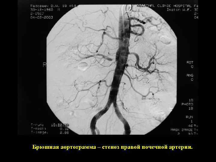 Брюшная аортограмма – стеноз правой почечной артерии. 