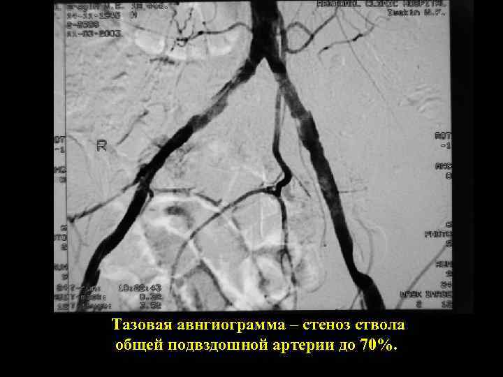Тазовая авнгиограмма – стеноз ствола общей подвздошной артерии до 70%. 