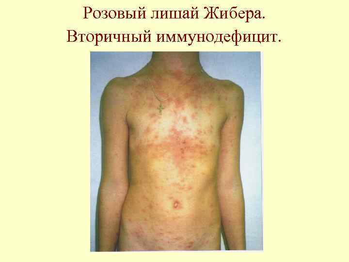 Розовый лишай Жибера. Вторичный иммунодефицит. 
