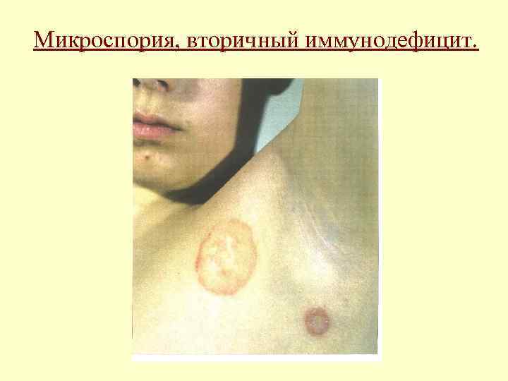 Микроспория, вторичный иммунодефицит. 