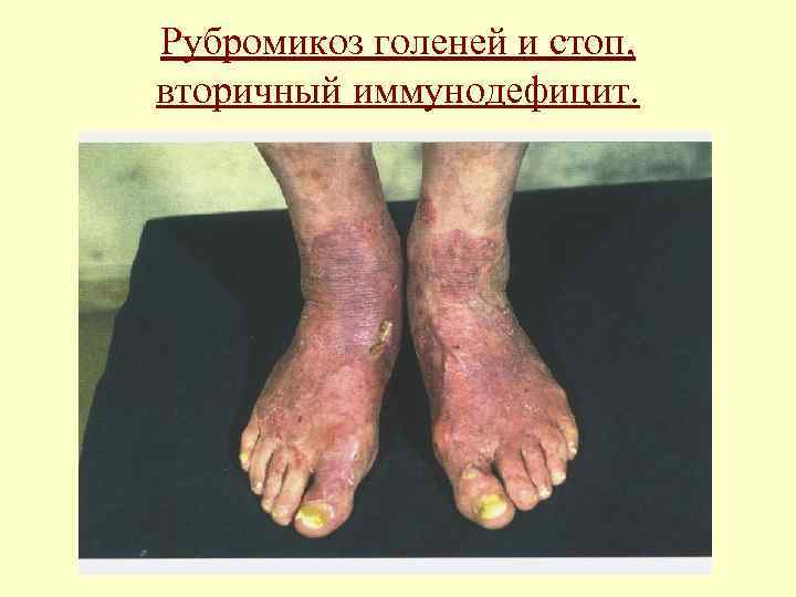 Рубромикоз голеней и стоп, вторичный иммунодефицит. 