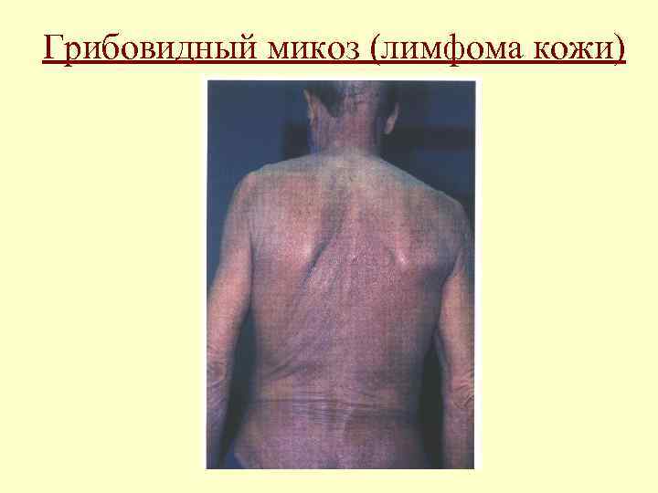 Грибовидный микоз (лимфома кожи) 