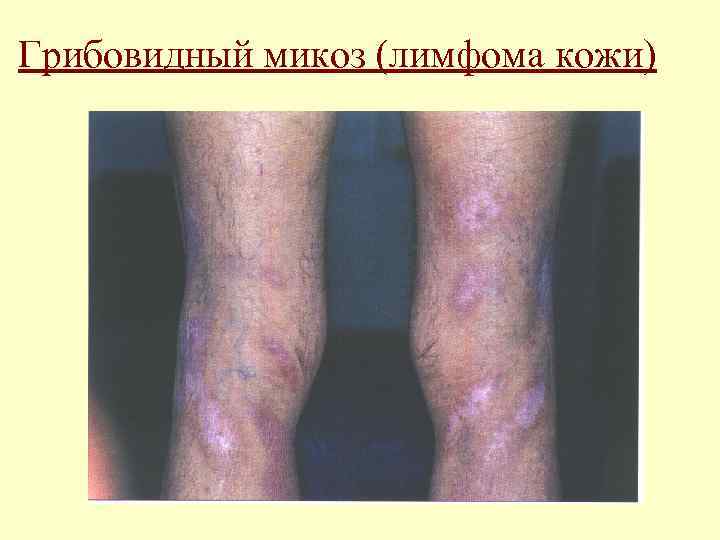 Грибовидный микоз (лимфома кожи) 