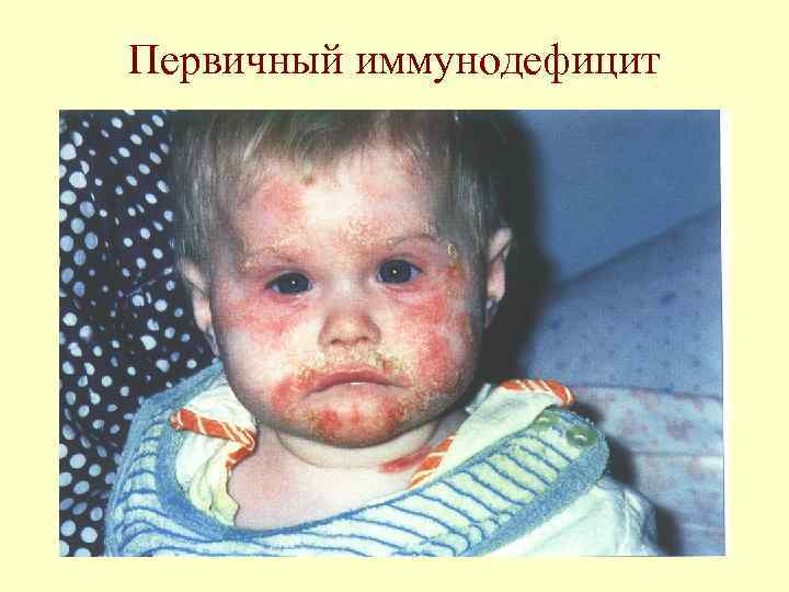 Первичный иммунодефицит 