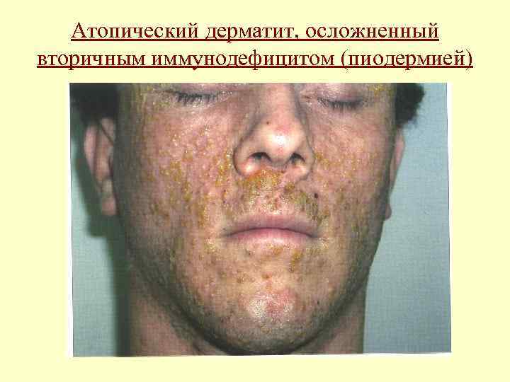 Атопический дерматит, осложненный вторичным иммунодефицитом (пиодермией) 