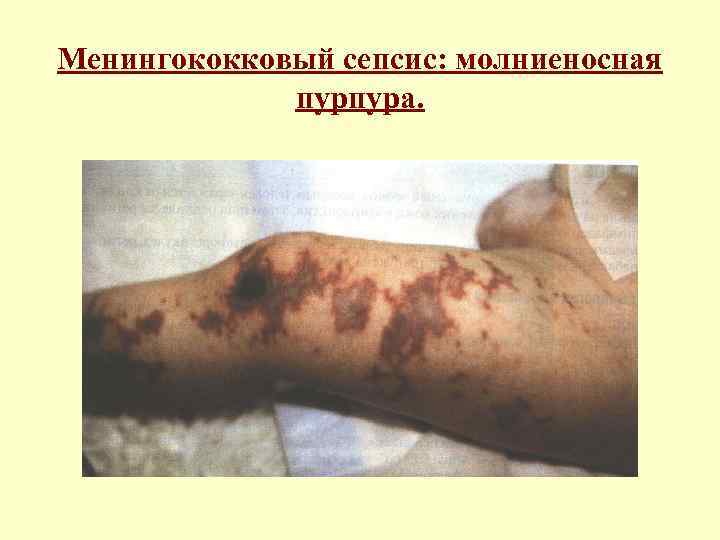 Менингококковый сепсис: молниеносная пурпура. 