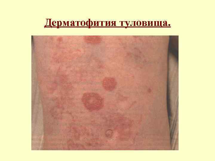 Дерматофития туловища. 