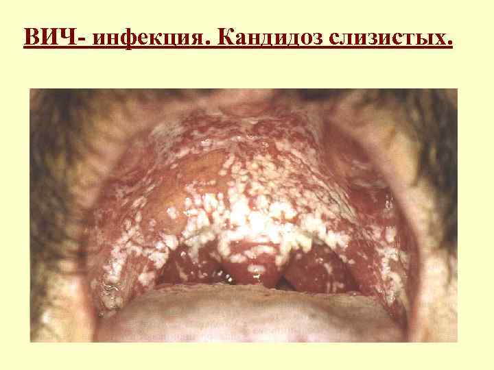 ВИЧ- инфекция. Кандидоз слизистых. 