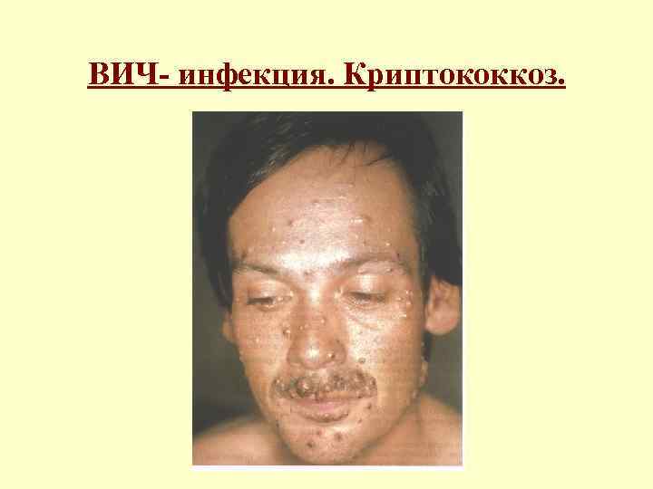 ВИЧ- инфекция. Криптококкоз. 
