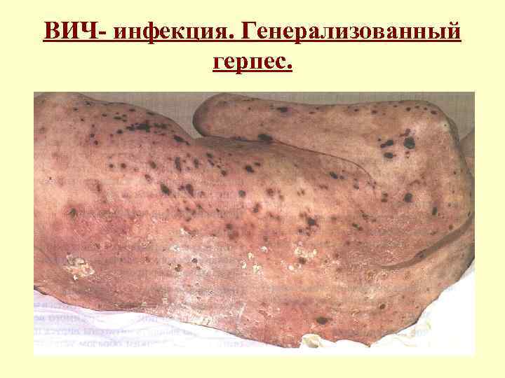 ВИЧ- инфекция. Генерализованный герпес. 