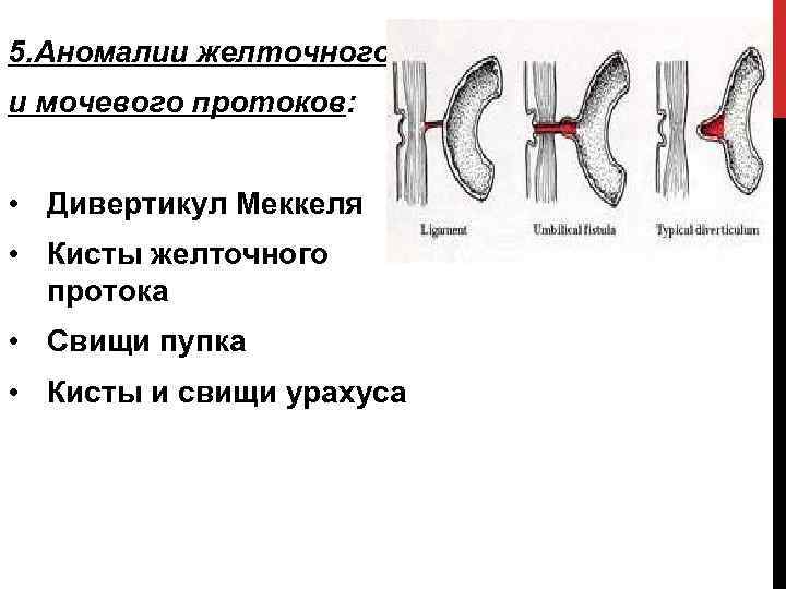 5. Аномалии желточного и мочевого протоков: • Дивертикул Меккеля • Кисты желточного протока •