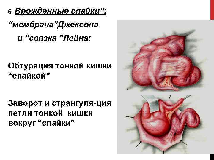 6. Врожденные спайки”: “мембрана”Джексона и “связка “Лейна: Обтурация тонкой кишки “спайкой” Заворот и странгуля-ция