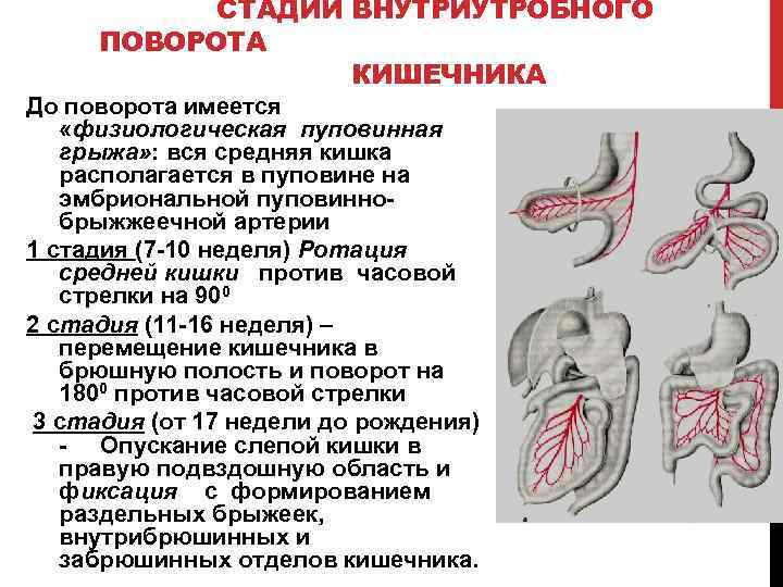 СТАДИИ ВНУТРИУТРОБНОГО ПОВОРОТА КИШЕЧНИКА До поворота имеется «физиологическая пуповинная грыжа» : вся средняя кишка