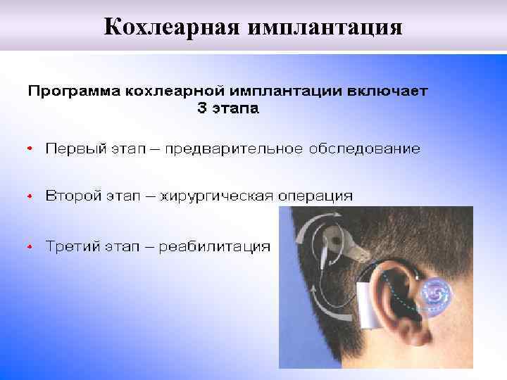 Кохлеарная имплантация 