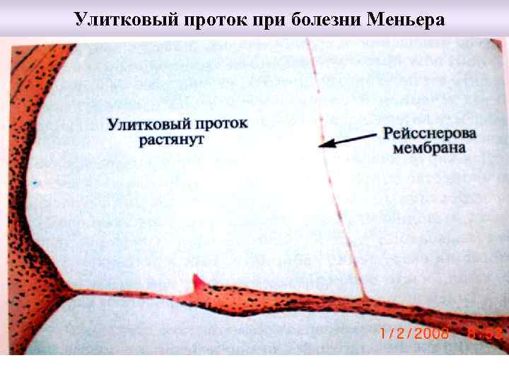 Улитковый проток при болезни Меньера 
