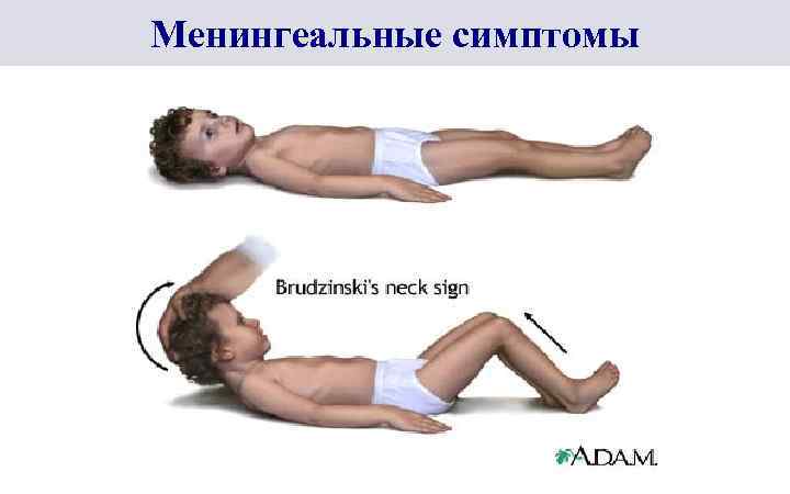 Менингеальные симптомы 